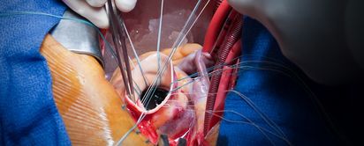 Budoucnost kardiochirurgie? Nové aortální chlopně